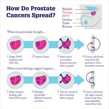As of now, the only way to know whether or not you have an aggressive or indolent prostate cancer is to go to a urologist and get screened for prostate cancer. Cancer S Common Core