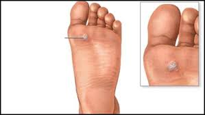 Check the front and back, then each side. Warts And Skin Cancers Family Foot Care