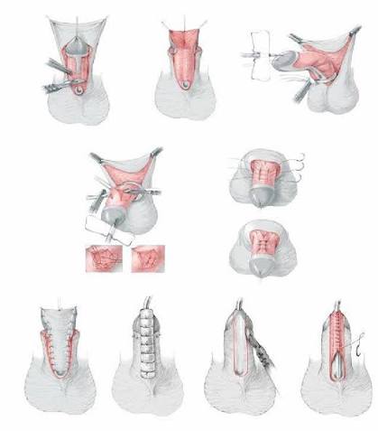 Steps of two stage repair: identification of chordee, excision of... |  Download Scientific Diagram