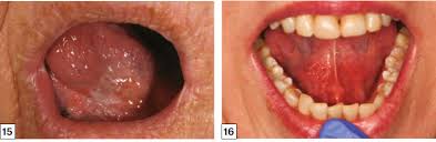 Read more articles on cancer in hindi. Racgp Common Benign And Malignant Oral Mucosal Disease