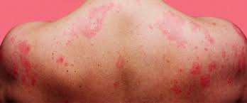 Sometimes they cause itchiness, sometimes they cause burning and your lips start to swell. What Even Are Stress Hives Anyway Dollar Shave Club Original Content