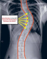 early stage scoliosis treatment