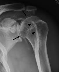 Image result for Biceps Tendon Injection
