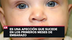 El labio leporino, la nariz y el paladar blando (la parte luego, el paladar duro (la parte frontal dura del surco del paladar) se repara entre los 15 y los 18 meses de edad. Salud Y Bienestar Labio Paladar Hendido Youtube