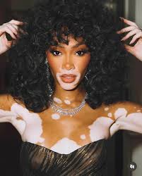 Image result for vitiligo model