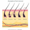Considering pain as a factor, hair removal creams are better than waxing. 1