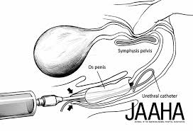 Image result for Urethral Catheterization
