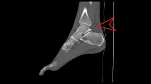 Image result for Traumatic Arthrotomy