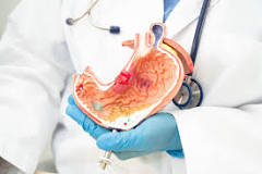 Balón gástrico: 5 ventajas y desventajas que debes conocer ...