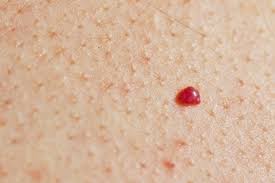 The red spot may be, bumpy, itchy, or otherwise irritated rash. What Do Red Spots On Skin Mean 13 Skin Spots Bumps Pictures