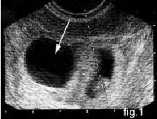 At this stage in a fetus' life its impossible to determine whether the twins are fraternal or identical. Ultrasound Scan At 7 Weeks Of Gestation An Empty Sac Arrow Is Noted Download Scientific Diagram