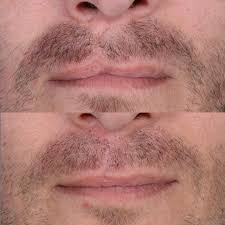Image result for Cleft Lip