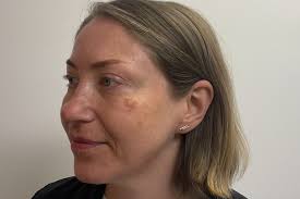 Image result for Solar Lentigo