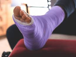 But when the cast comes off and your back on your feet stand on your injured ankle and foot for an extended period to improve your balance. Broken Foot Symptoms What To Expect