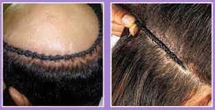 Whereas hair transplants actually produce and grow new hair, hair weaving is a temporary solution that requires a lot of maintenance. Hair Weaving Treatment What One Should Know