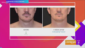 Seventeen us states have officially backed the texas complaint to the us supreme court alleging that four states that certified the presidential election for democrat joe biden mismanaged them in. Getting Rid Of The Zoom Chin With The Help Of Vitalyc Medspa Wfaa Com