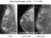 Mikroverkalkungen Ein Knoten In Der Brust Wie Gehe Ich Nun Vor