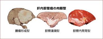 「胆管がん」の画像検索結果
