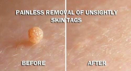 Skin tag removal product image