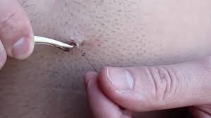 Home remedies to get rid of they also point out the correct way of removing the hair so that it doesn't lead to an ingrown hair. Longest Ingrown Hair Removal Ever Medical Videos