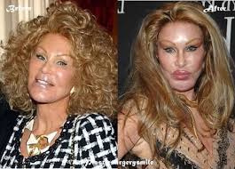 Catwoman Plastic Surgery The Best Example Of Disaster Celebrity Plastic Surgery Plastic Surgery Cosmetic Surgery