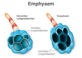 Copd Was Ist Copd Copd Symptome Definition Pflege De