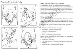Image result for External Cephalic Version