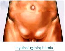 Image result for Inguinal hernia man