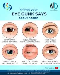 Image result for Eye Discharge