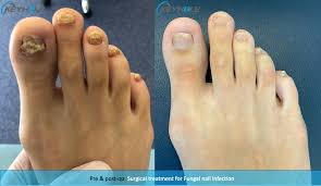 Fungal Nail Treatment Perth Podiatric Surgery