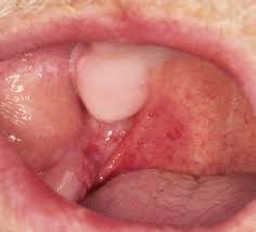 Image result for Erythroplakia roof of mouth