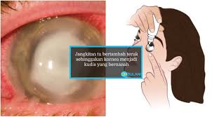 Kudis buta ataupun lebih dikenali sebagai scabies, merupakan sejenis penyakit kulityang mudah berjangkit. Selamatkah Ubat Titis Mata Anda Ini Penjelasan Doktor Yang Perlu Anda Ambil Tahu