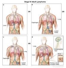 Image result for Lymphoma