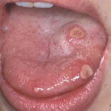 Image result for Puchýře na jazyku