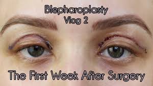 Especially if the problem is identified at the initial stage, and its cause is lack very often in our time in beauty salonswomen turn when they find a hernia under their eyes on their face. How To Fix Hooded Eyes With Surgery Arxiusarquitectura