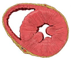 Left Ventricular Hypertrophy Wikipedia
