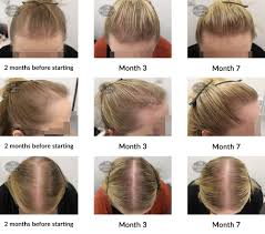 We've put together this handy little hair growth infographic to help you figure out what's normal as well as tips for helping your hair grow. Hair Growth Success Story Delighted With The Results So Far