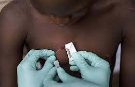 Monkeypox definition monkeypox is an infectious disease caused by an orthopoxvirus. H2uneyimfpkdsm