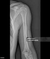 Image result for Elbow XRay