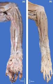 Common flexor tendon from medial epicondyle of humerus ulnar head: Evolutionary And Terminological Analysis Of The Flexor Digitorum Superficialis Interflexorii And Palmaris Longus Muscles In Kinkajou Potos Flavus And Crab Eating Racoon Procyon Cancrivorus Perdomo Cardenas Anatomia Histologia Embryologia