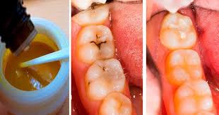 простуда на губе как быстро вылечить в домашних условиях Kak Izbavitsya Ot Kariesa V Domashnih Usloviyah Kak Vylechit Karies Samodelnaya Zubnaya Pasta Karies