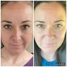 Acne remediation oil and pomifera serums for teenage acne