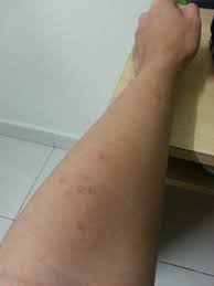 Mengobati gatal bintik merah ampuh dengan radisional:eksim adalah penyakit kulit yang membentuk lepuh atau gelembung kecil pada lapisan kulit. Wdf Wai Ah When I Woke Up My Hand Got One Biji