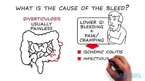 Other symptoms of colon cancer besides blood mixed with feces: Lower Gi Bleeding The 3 Steps To Take When You Aren T Sure Of The Source Youtube