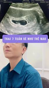 Thai 7 tuần: Dấu hiệu và hình ảnh phát triển