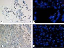 Patients with epithelioid mesothelioma may experience: Highlights Of The 14th International Mesothelioma Interest Group Meeting Pathologic Separation Of Benign From Malignant Mesothelial Proliferations And Histologic Molecular Analysis Of Malignant Mesothelioma Subtypes Lung Cancer