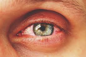 Torn Contact Lenses Here S How To Say Goodbye To Rips For Good Lenspure