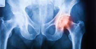 C'est pourquoi il n'est guère possible de proposer plus de deux injections de corticoïdes par an. Arthrose Ne Terminez Pas En Chaise Roulante