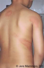 The hives live at third man records recorded straight onto acetate and being released to you on vinyl and digital sept 25, 2020. Urticaria American Osteopathic College Of Dermatology Aocd