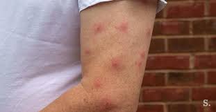 Mosquitoes get infected and carry the virus after biting infected birds. What Does West Nile Virus Rash Look Like